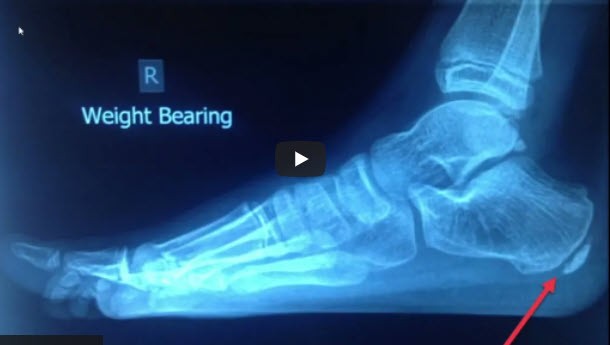 Severs disease xray